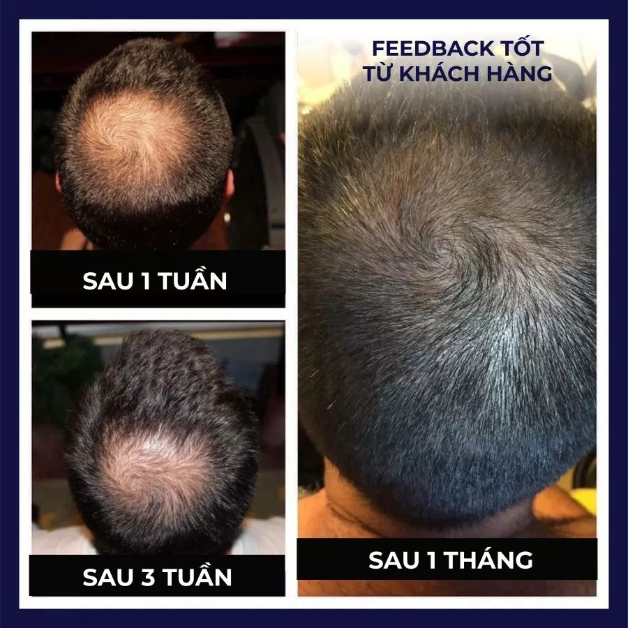 EFG Hair Growth Spray Regeneration & Massive growth in Days